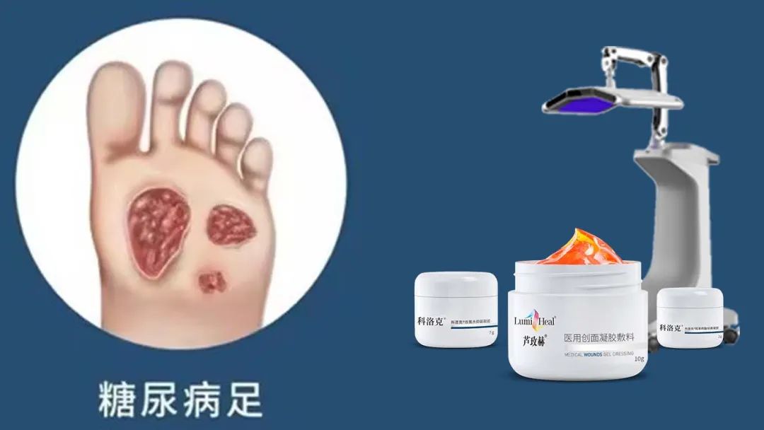 新品蘆玫赫：引領(lǐng)糖尿病足治療進(jìn)入再生光技術(shù)新時代